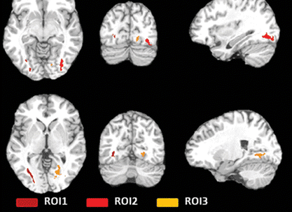 Soccer Heading Is Associated with White Matter Microstructural and Cognitive Abnormalities