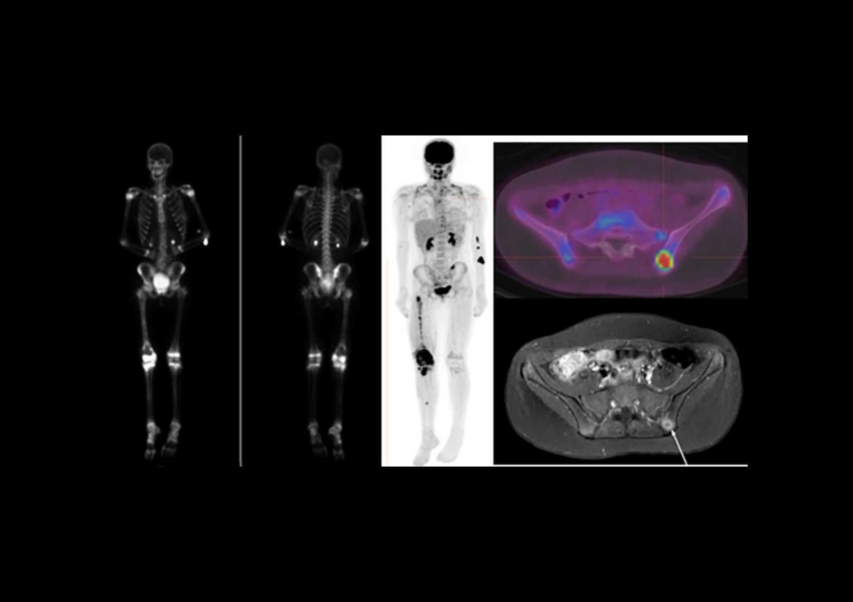 The Utility of 18FDG PET/CT Versus Bone Scan for Identification of Bone Metastases in a Pediatric Sarcoma Population and a Review of the Literature
