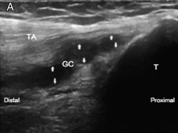 Immediate Improvement of Deep Fibular Nerve Palsy After US-Guided Tibiofibular Joint Ganglion Cyst Aspiration